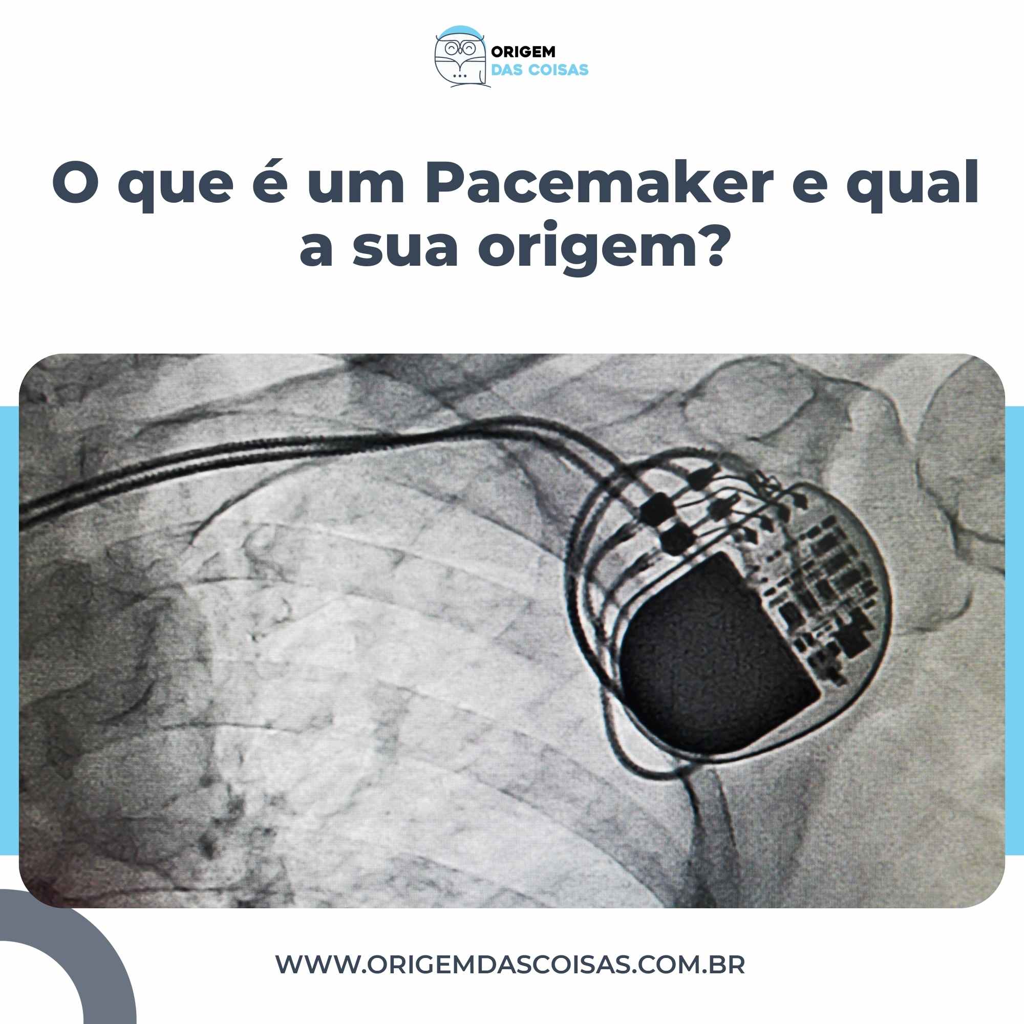 O que é um Pacemaker e qual a sua origem?